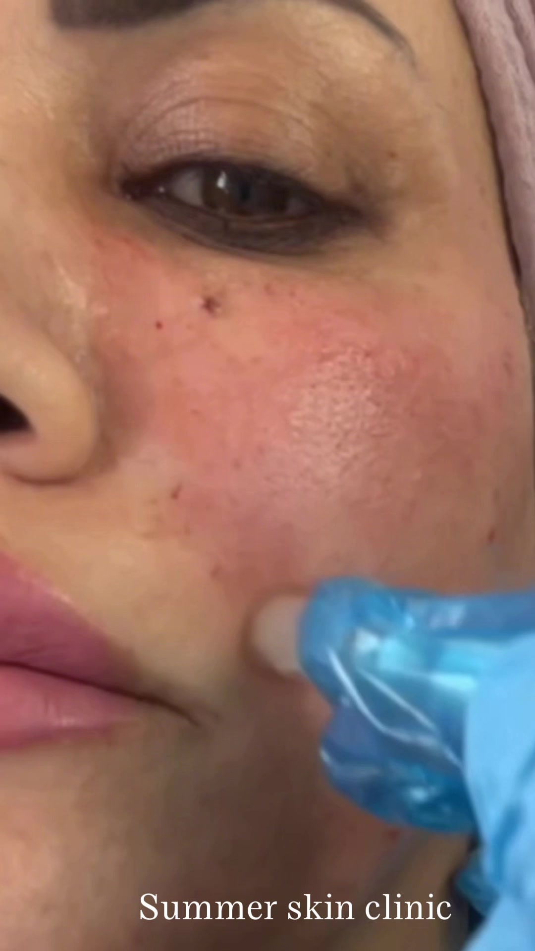 @Summer Skin Clinic | Toronto