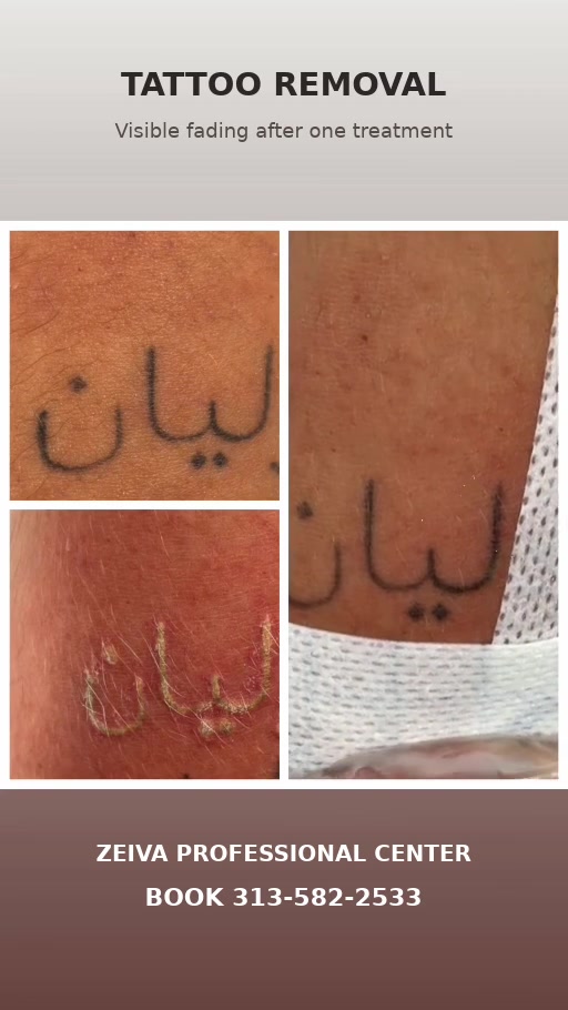 @Zeiva laser /Dearborn MI