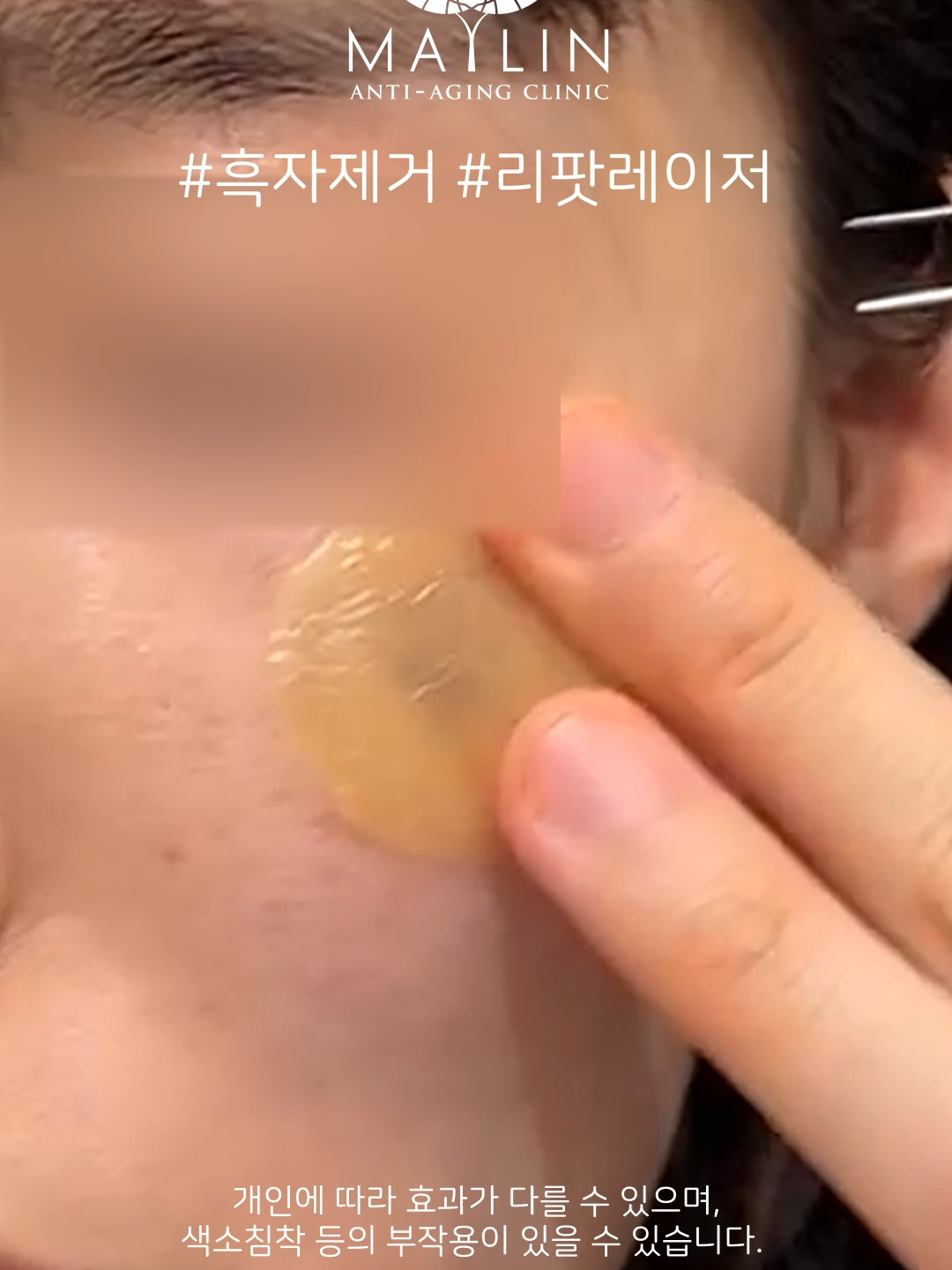 @메이린의원대구점