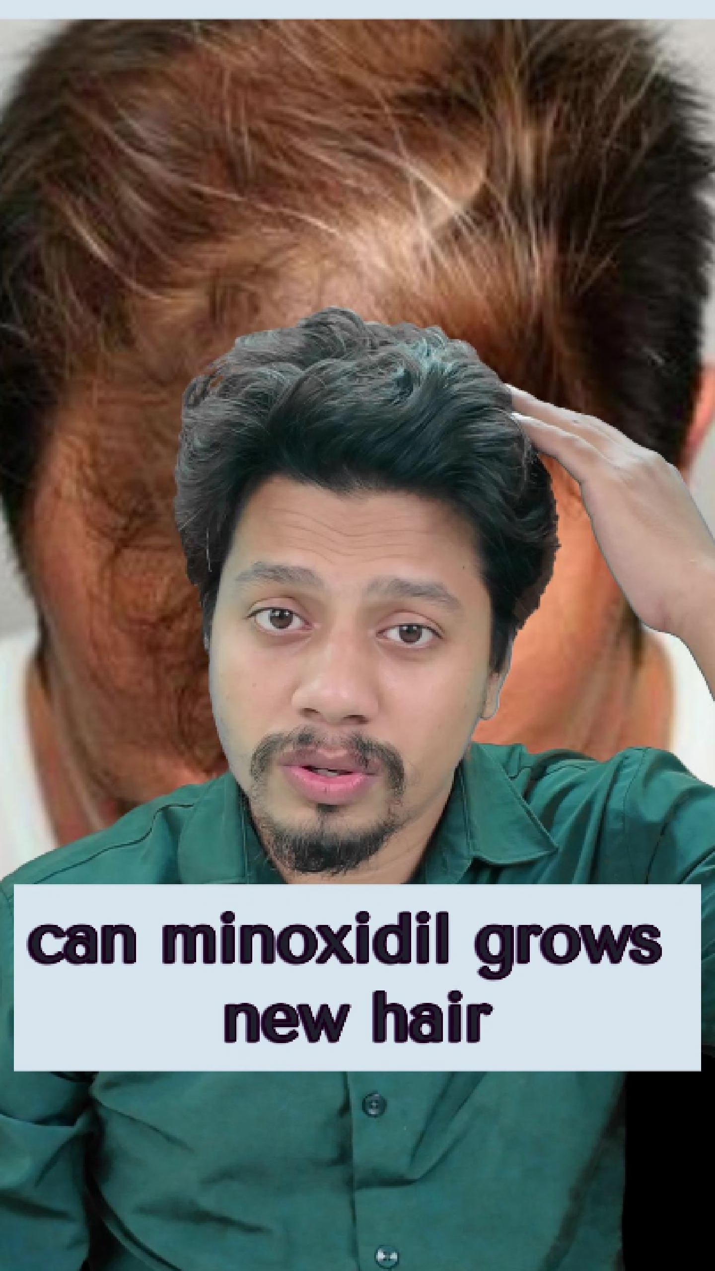@NAZID HAIR TRANSPLANT