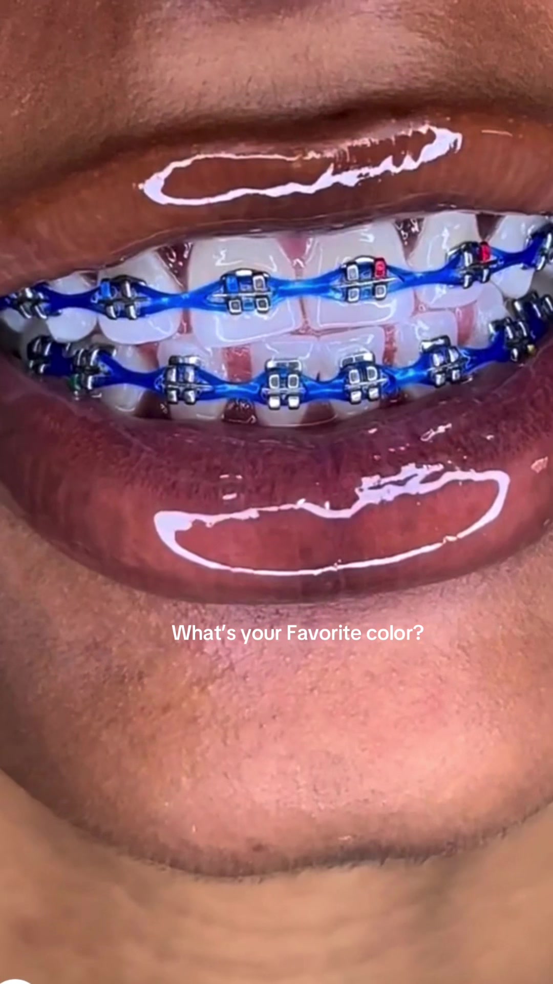 @bracesjunkie