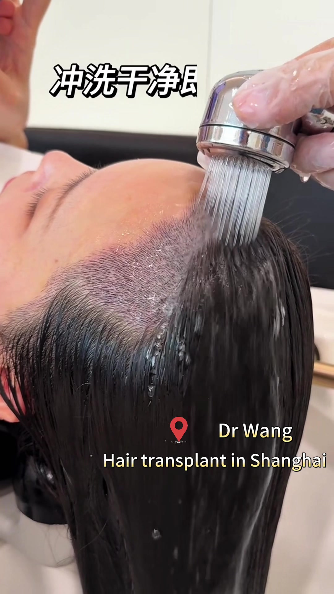 @HAIR TRANSPLANT WANG🇨🇳
