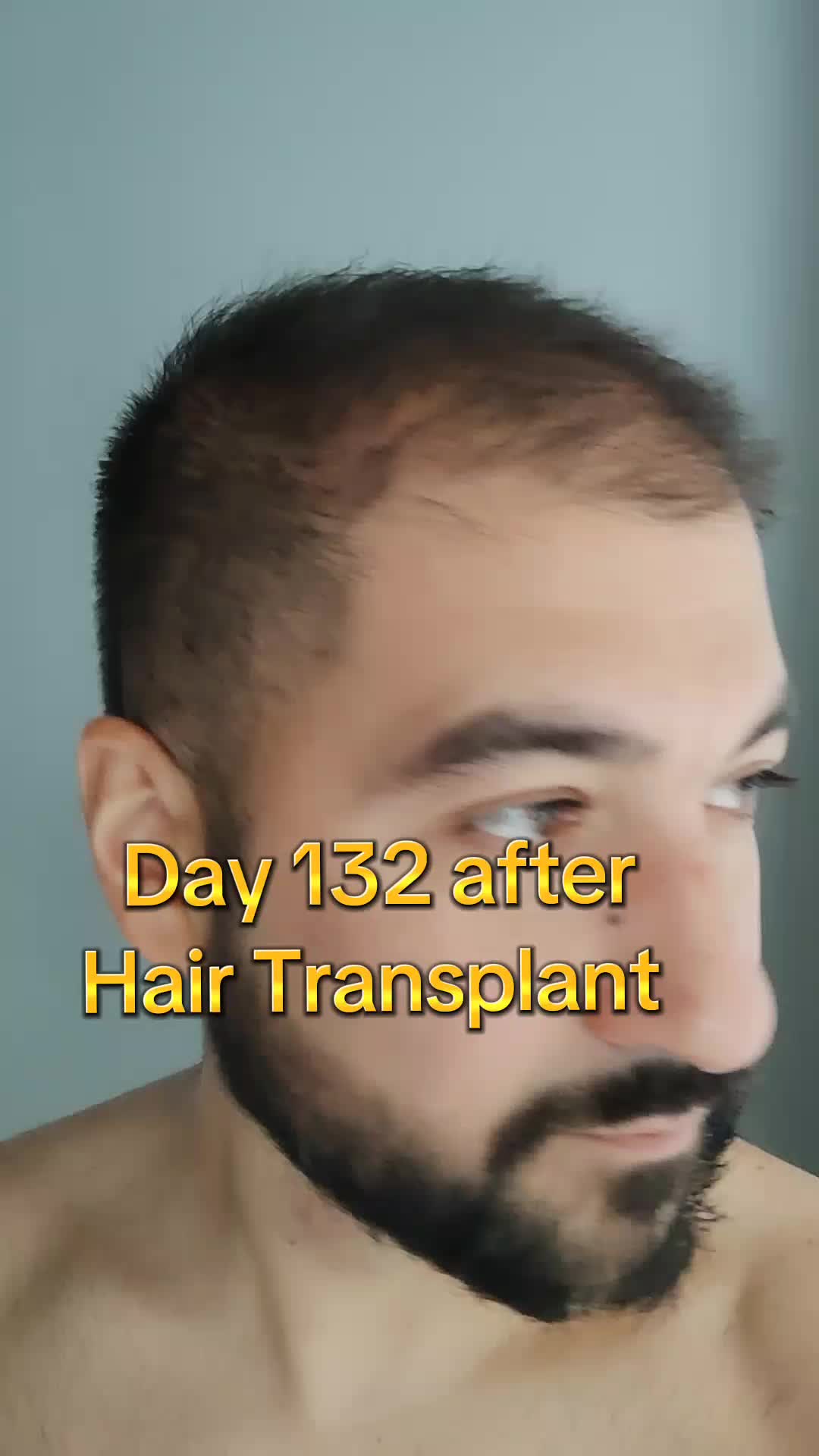@My hair transplant