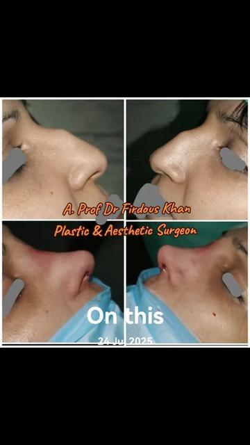 @Dr Firdous Khan PlasticSurgeon