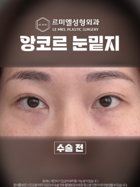 @르미엘성형외과