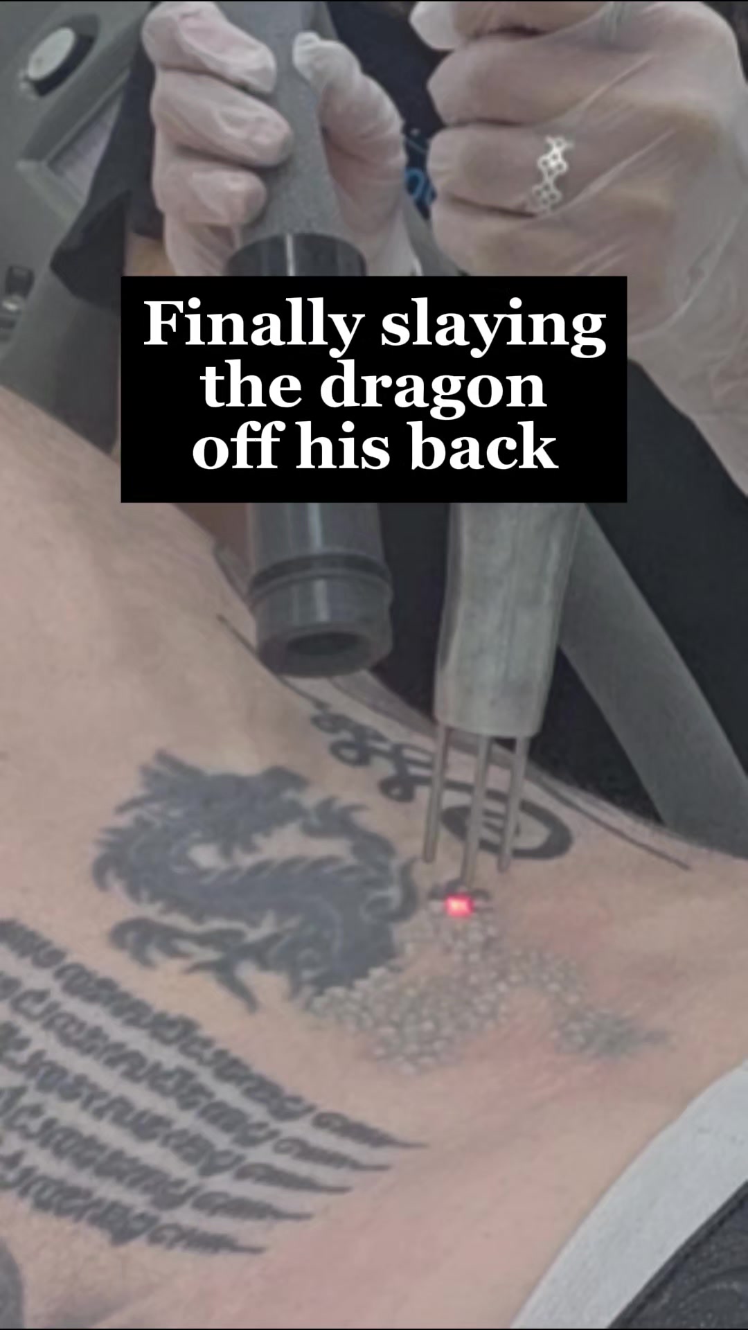 @Jamie T| Tattoo Removal Expert