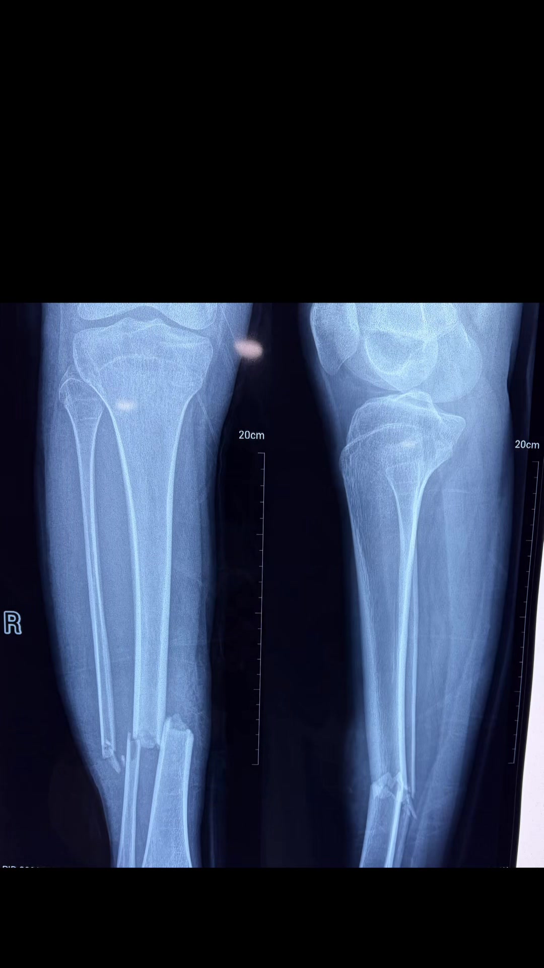 @Orthopedic_Surgeon_Arbind