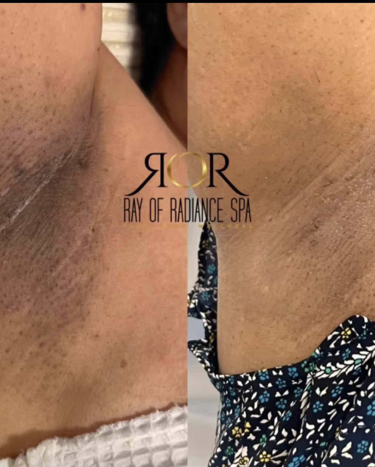 @Rosey-FL Esthetician/laserTech