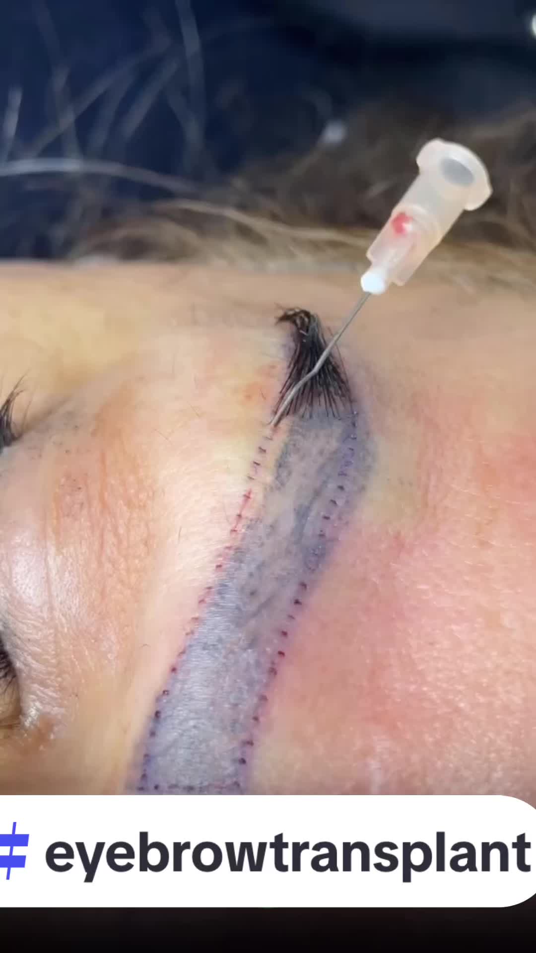 @Eyebrows Transplant