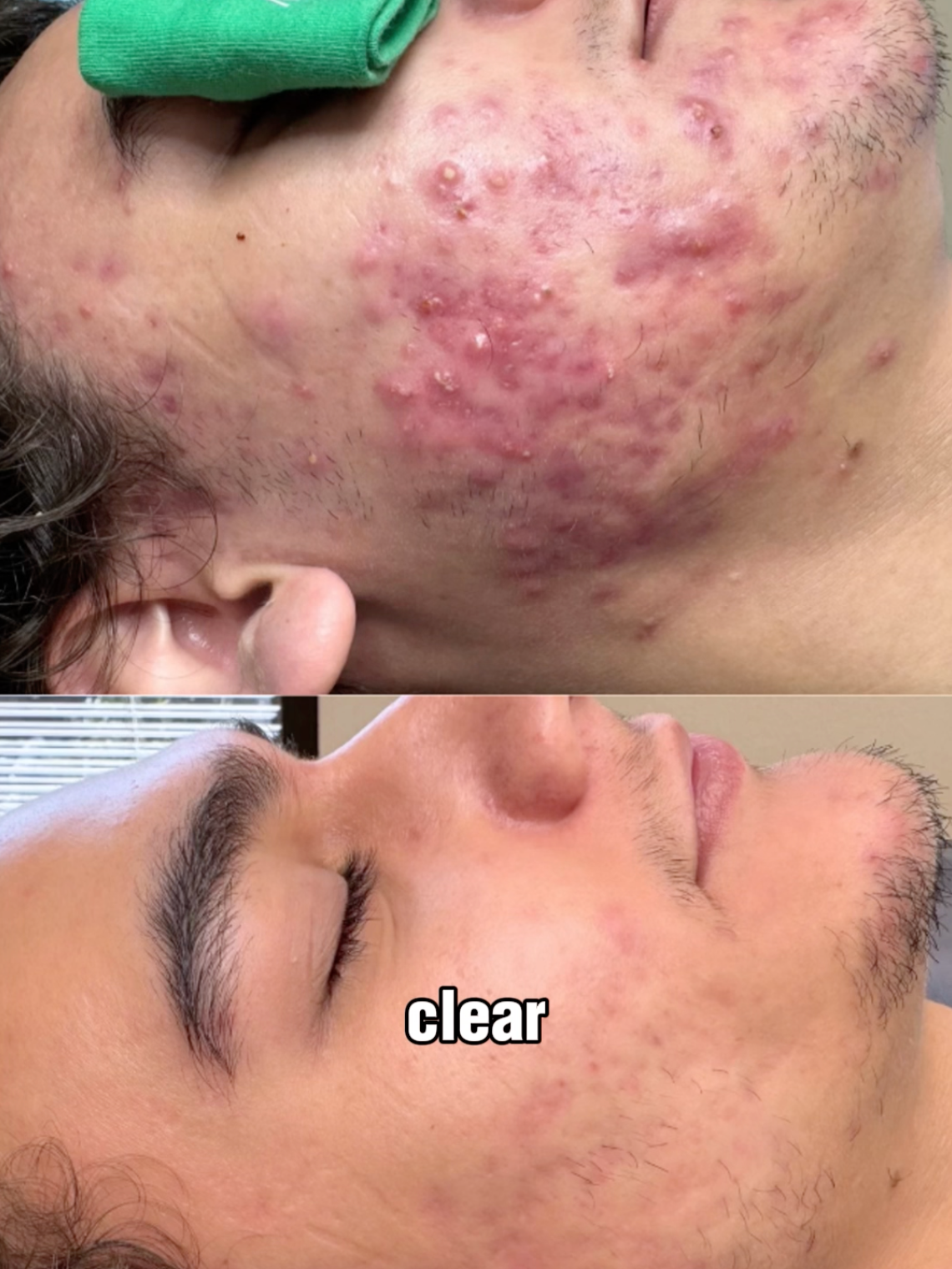 @Skin Plus Acne Clinic ATX