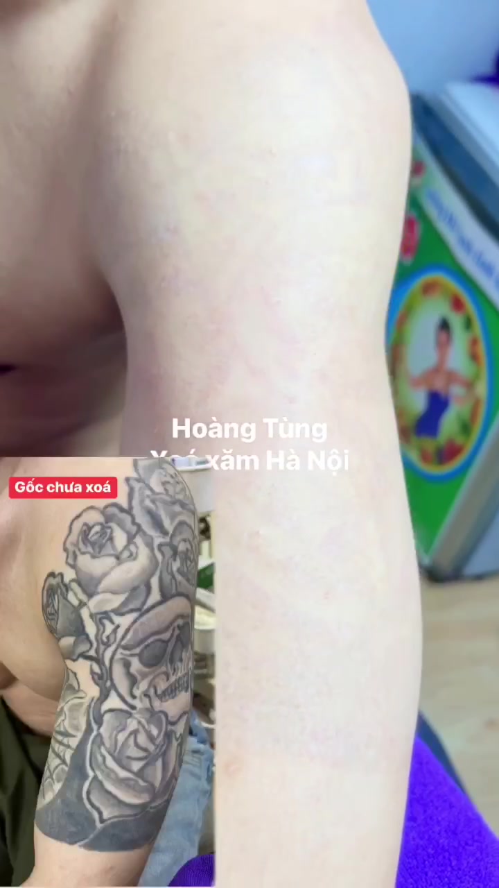 @Xo&aacute; xăm k sẹo H&agrave; Nội💧