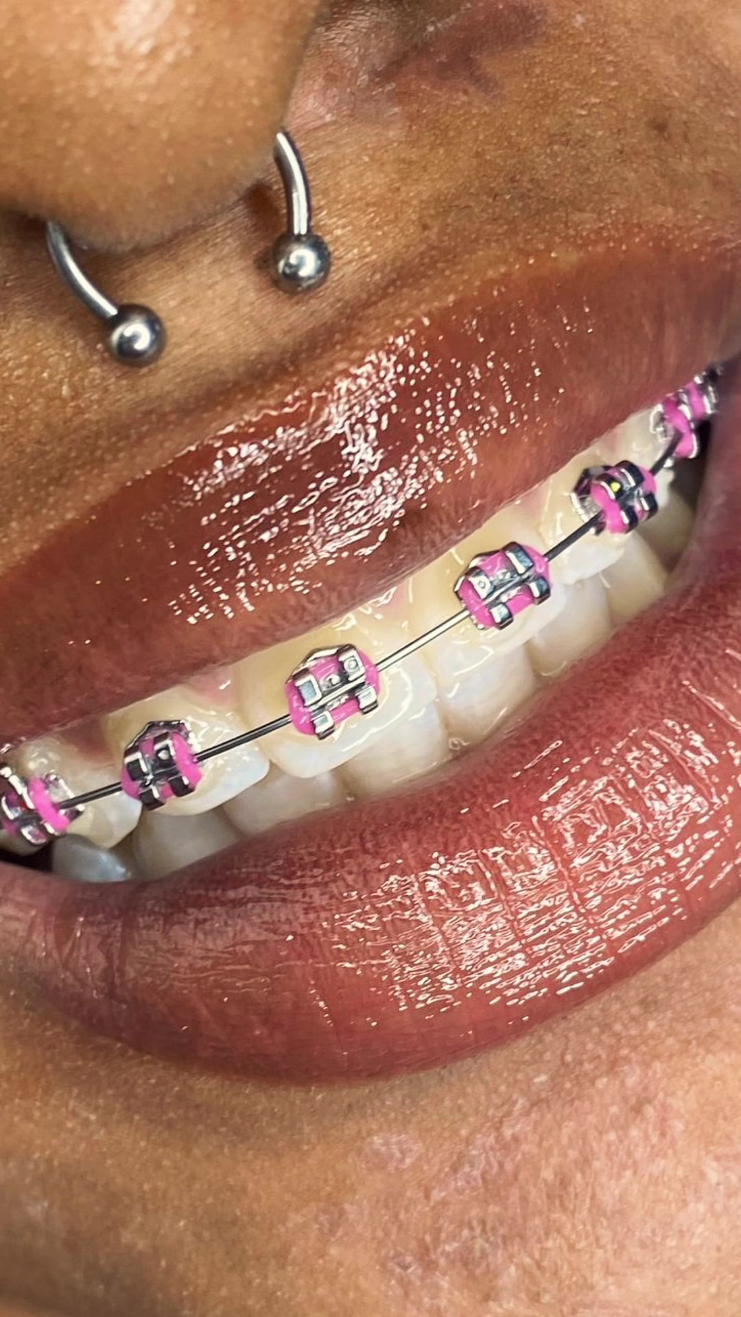 @MG BRACES