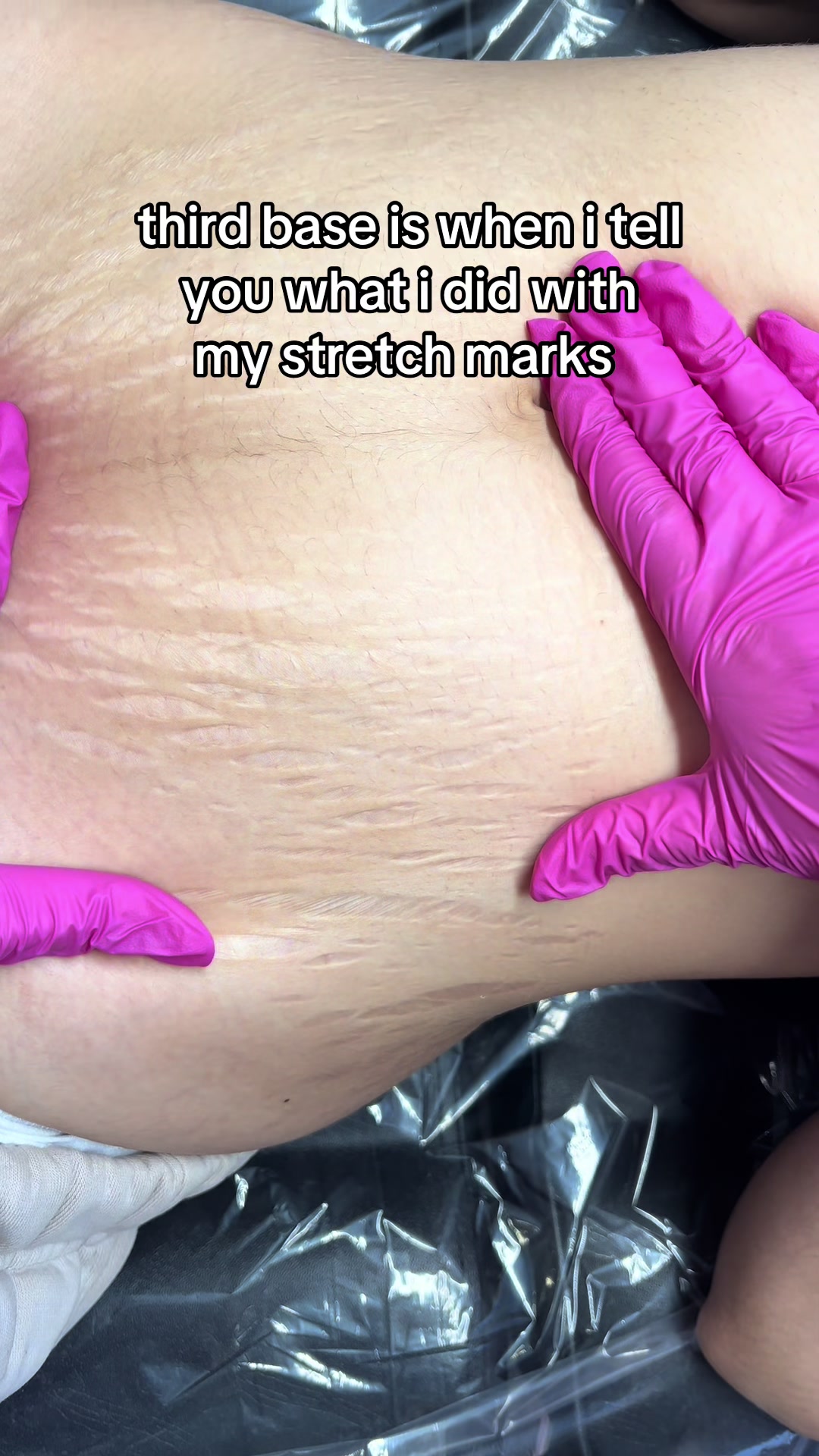@Stretch Mark Fairy 🧚✨