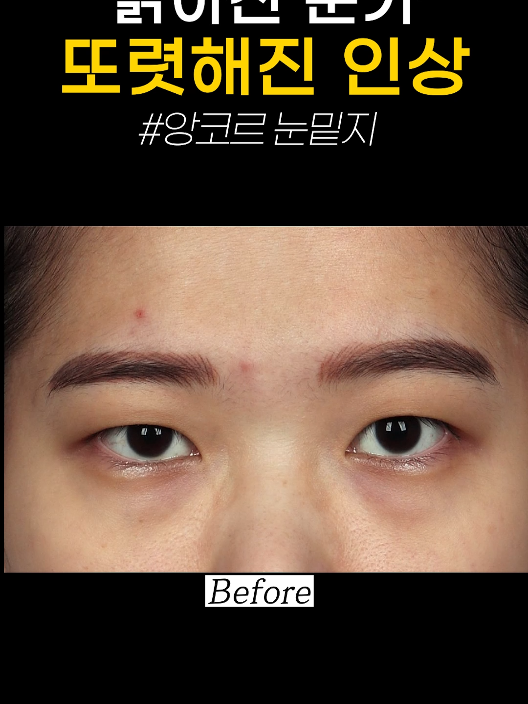 @르미엘성형외과