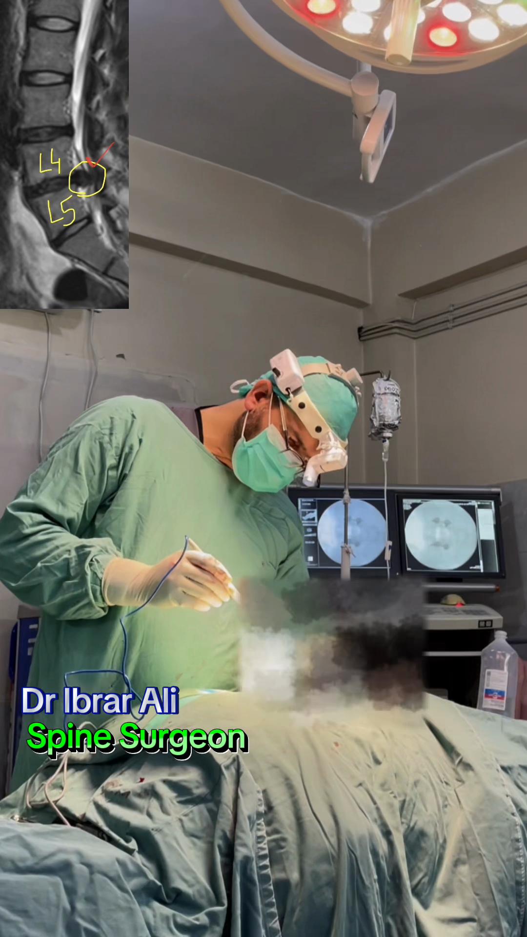 @@Dr.Ibrar Spine &Ortho Surgeon