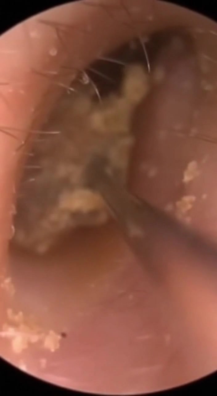 @Ear Cleaning