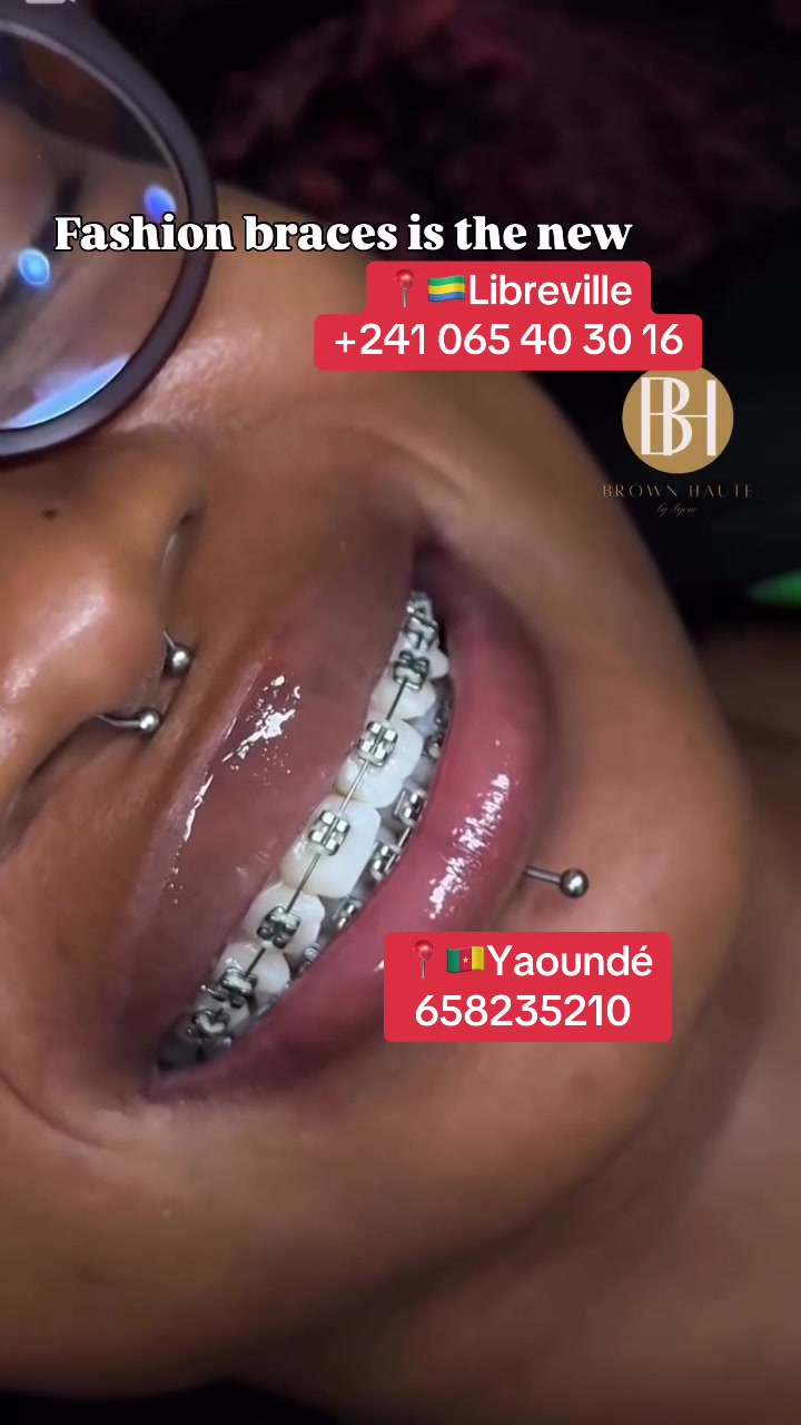 @MG BRACES
