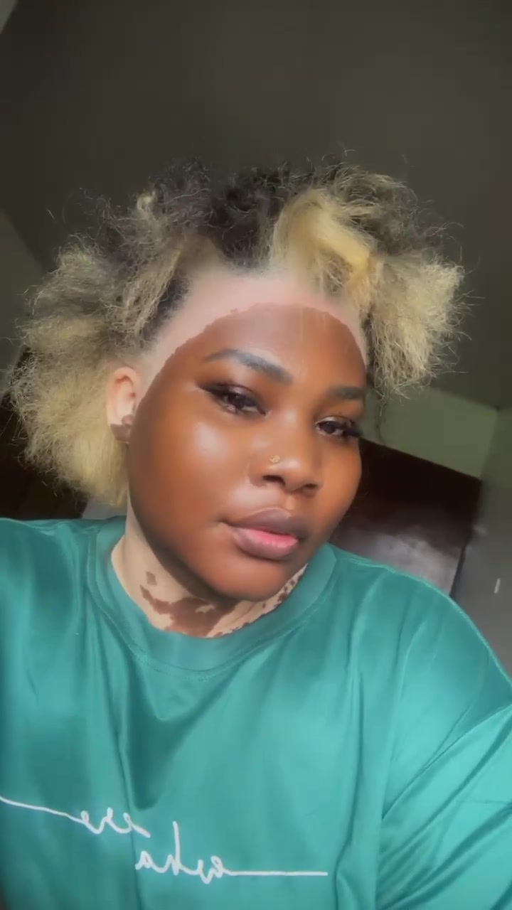 @Thevitiligogirl