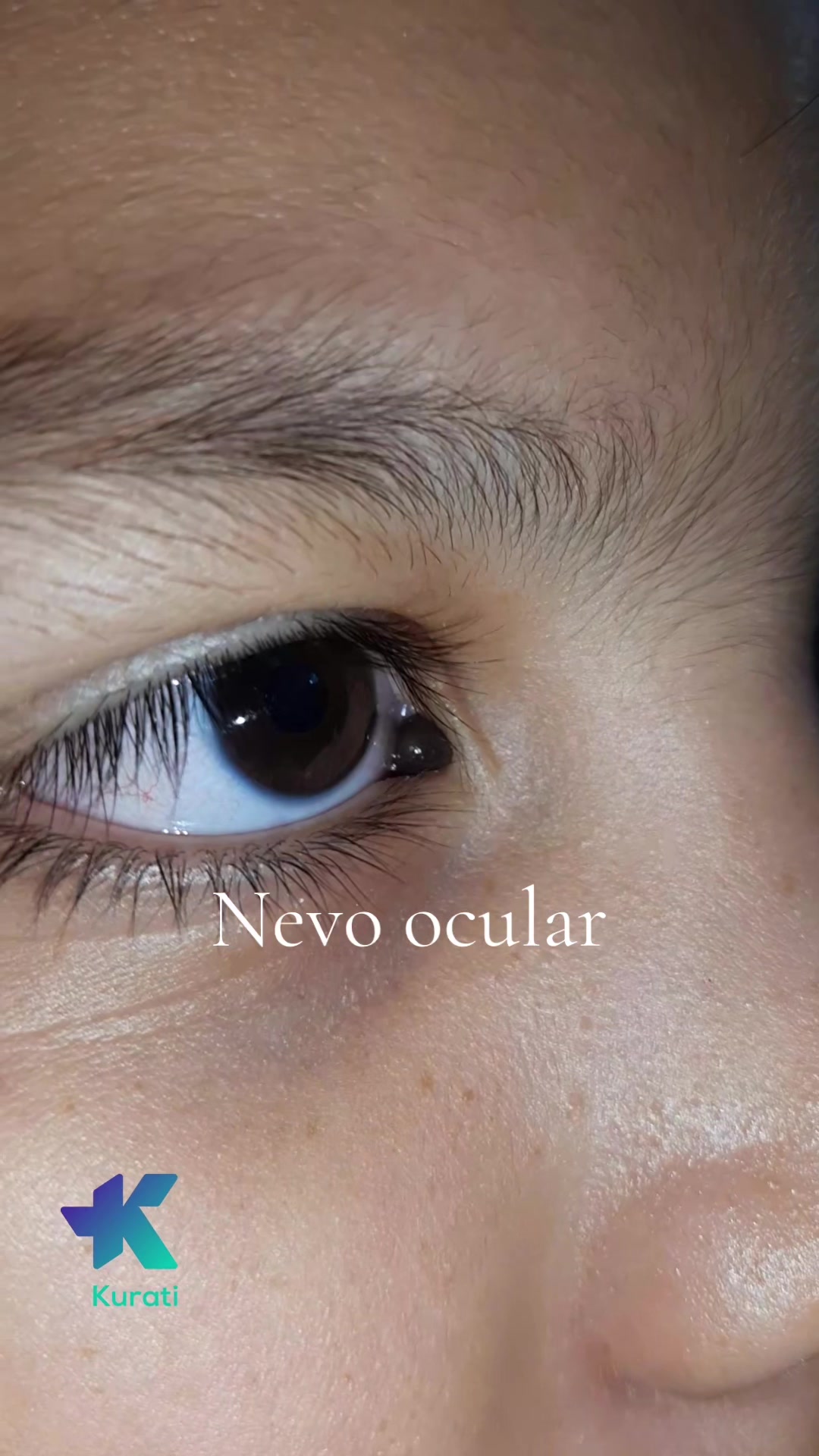 @Kurati | Oftalmolog&iacute;a