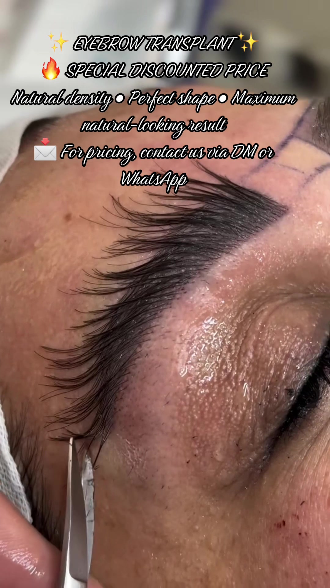 @Eyebrows Transplant