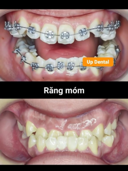 @Nha khoa niềng răng Up Dental