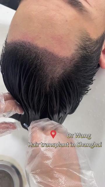 @HAIR TRANSPLANT WANG🇨🇳