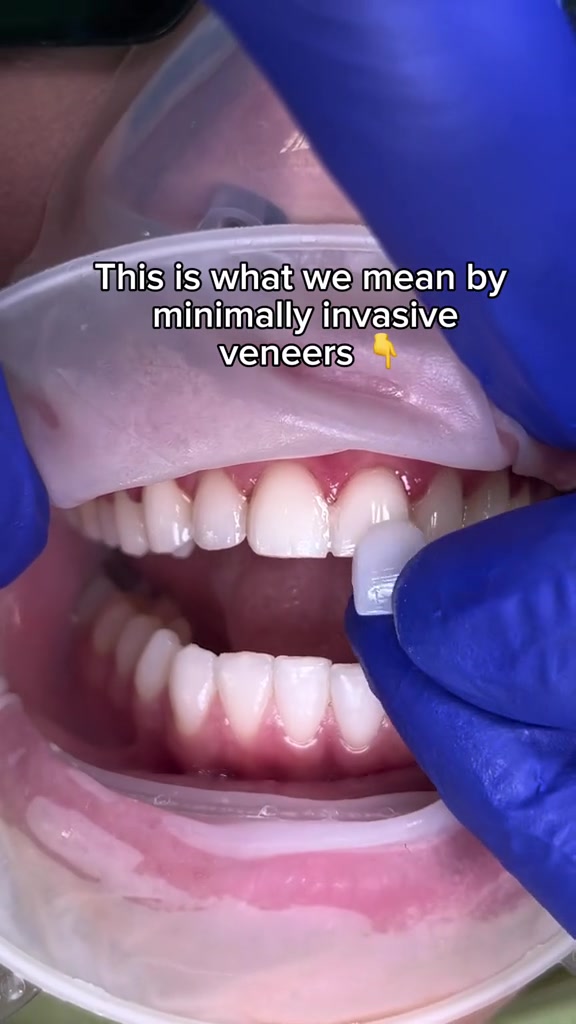 @Veneers