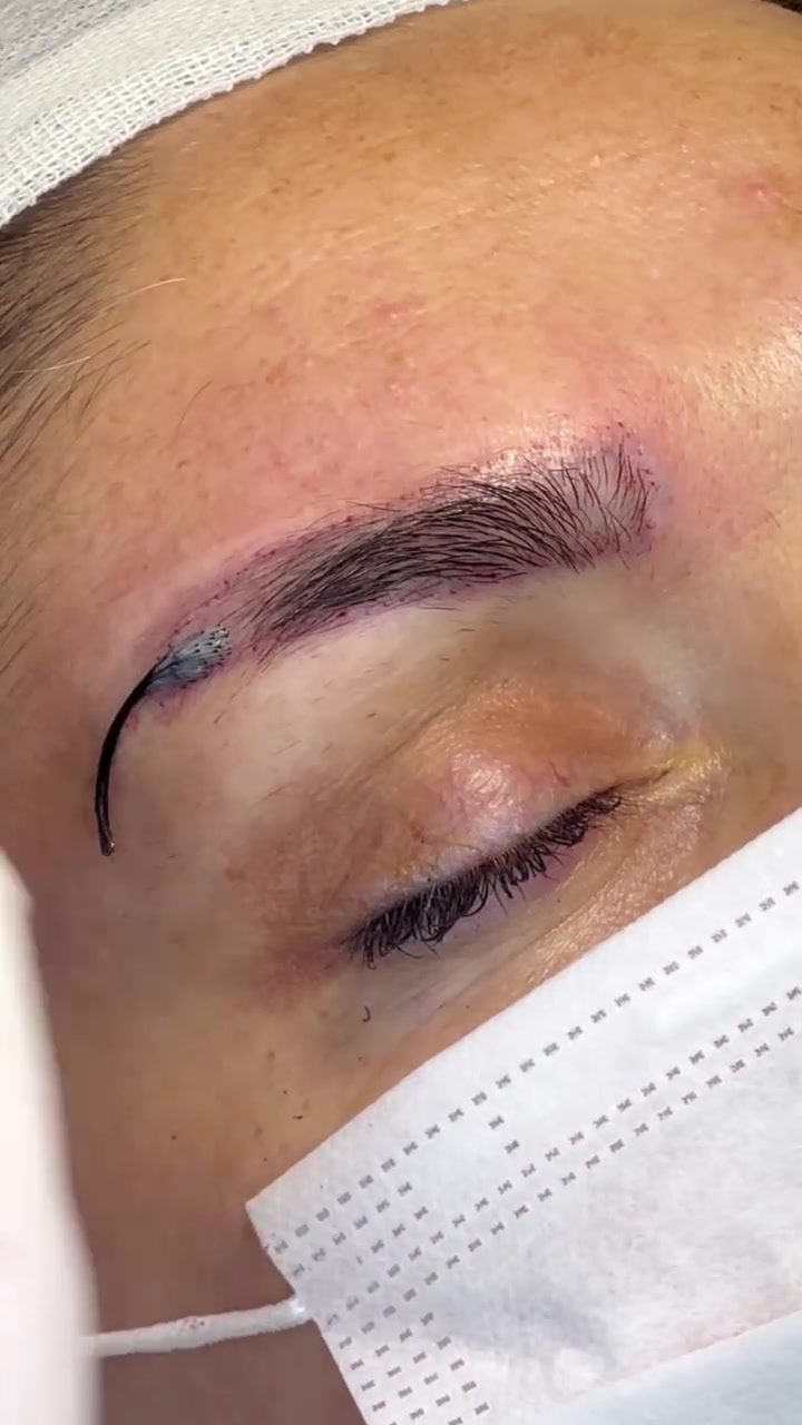 @Eyebrows Transplant