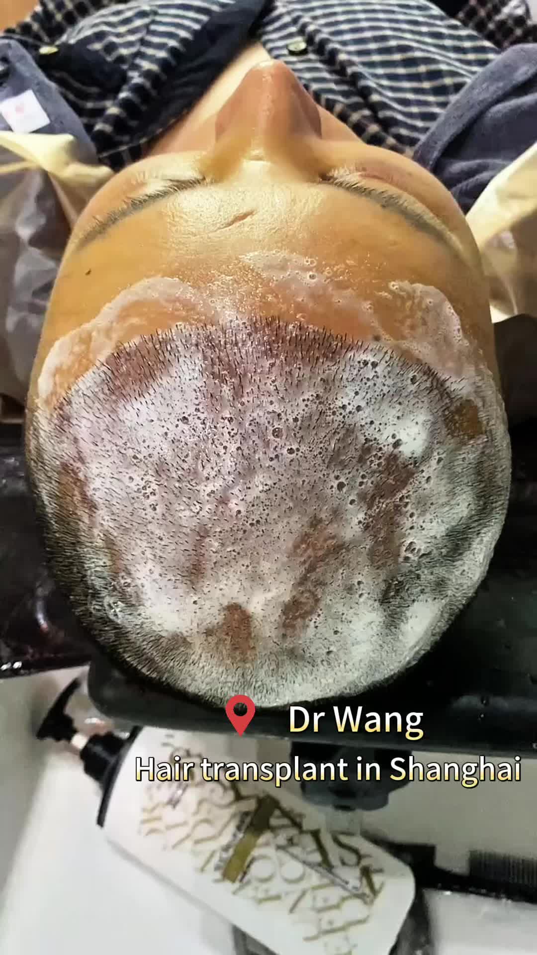 @HAIR TRANSPLANT WANG🇨🇳