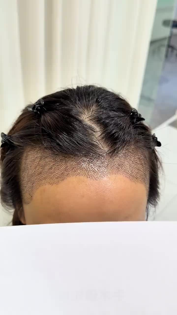 @HAIR TRANSPLANT WANG🇨🇳
