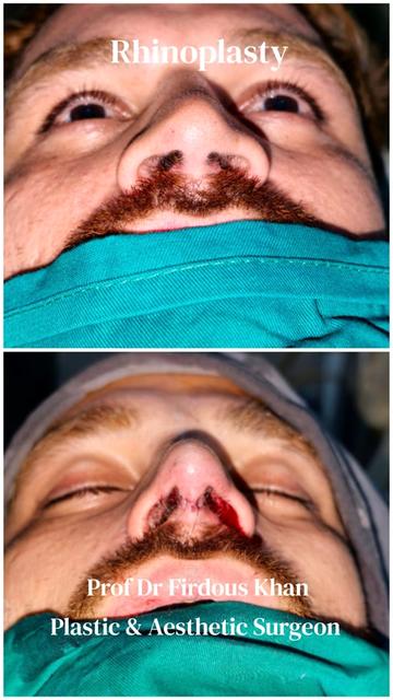@Dr Firdous Khan PlasticSurgeon