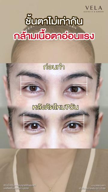 @เวลาคลินิก ตาสองชั้น ถุงใต้ตา