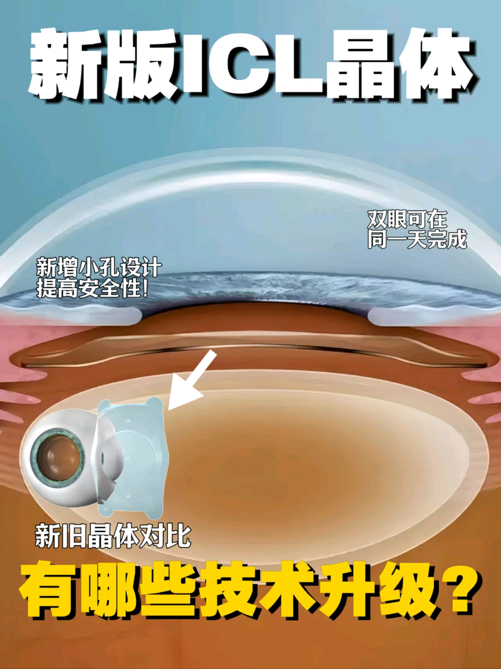 @🇺🇸西雅图/波特兰 King  Lasik 近视老花手术
