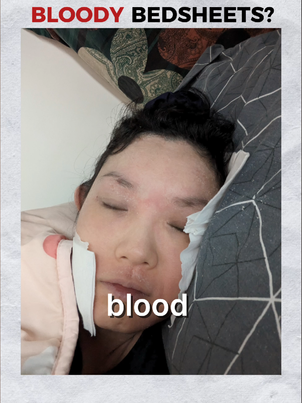 @Grace | TSW & Eczema Recovery