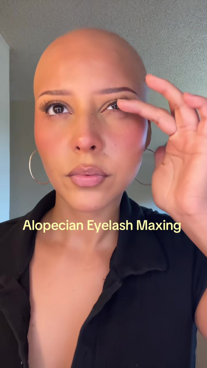 @AlopecianPrincess