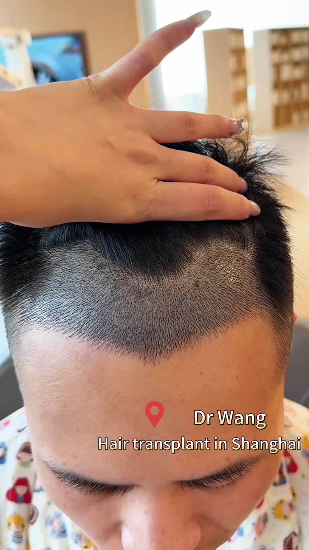 @HAIR TRANSPLANT WANG🇨🇳