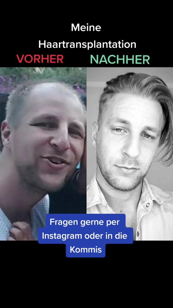 @Mr. Hairtransplant