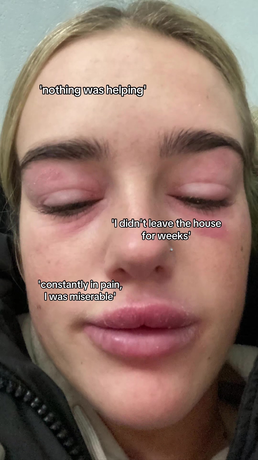 @Eczema Diaries USA & UK