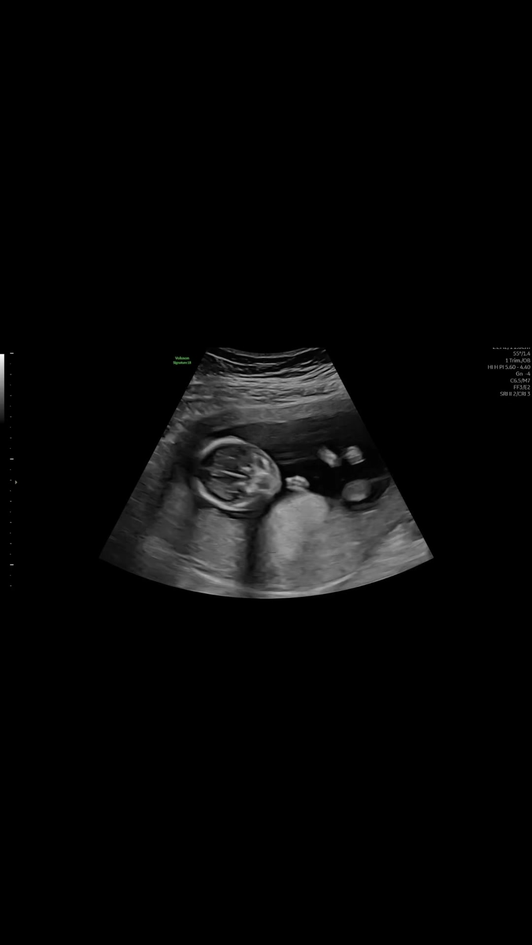@Stacey🌸| Pregnancy after loss