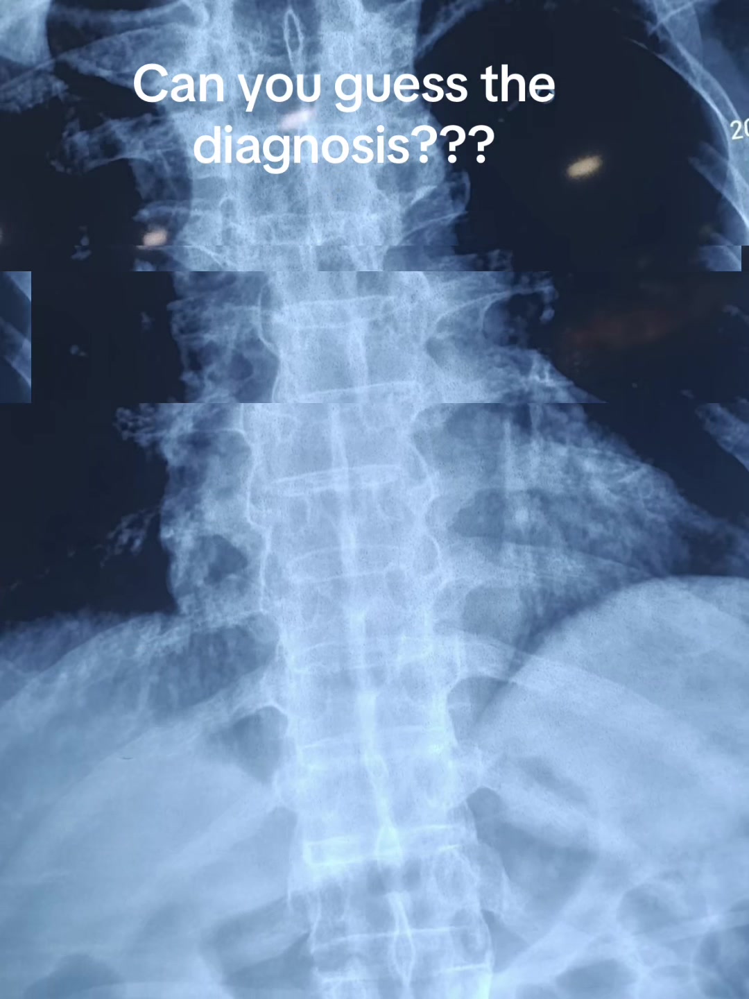 @Spine_Ortho_Surgeon_Arbind