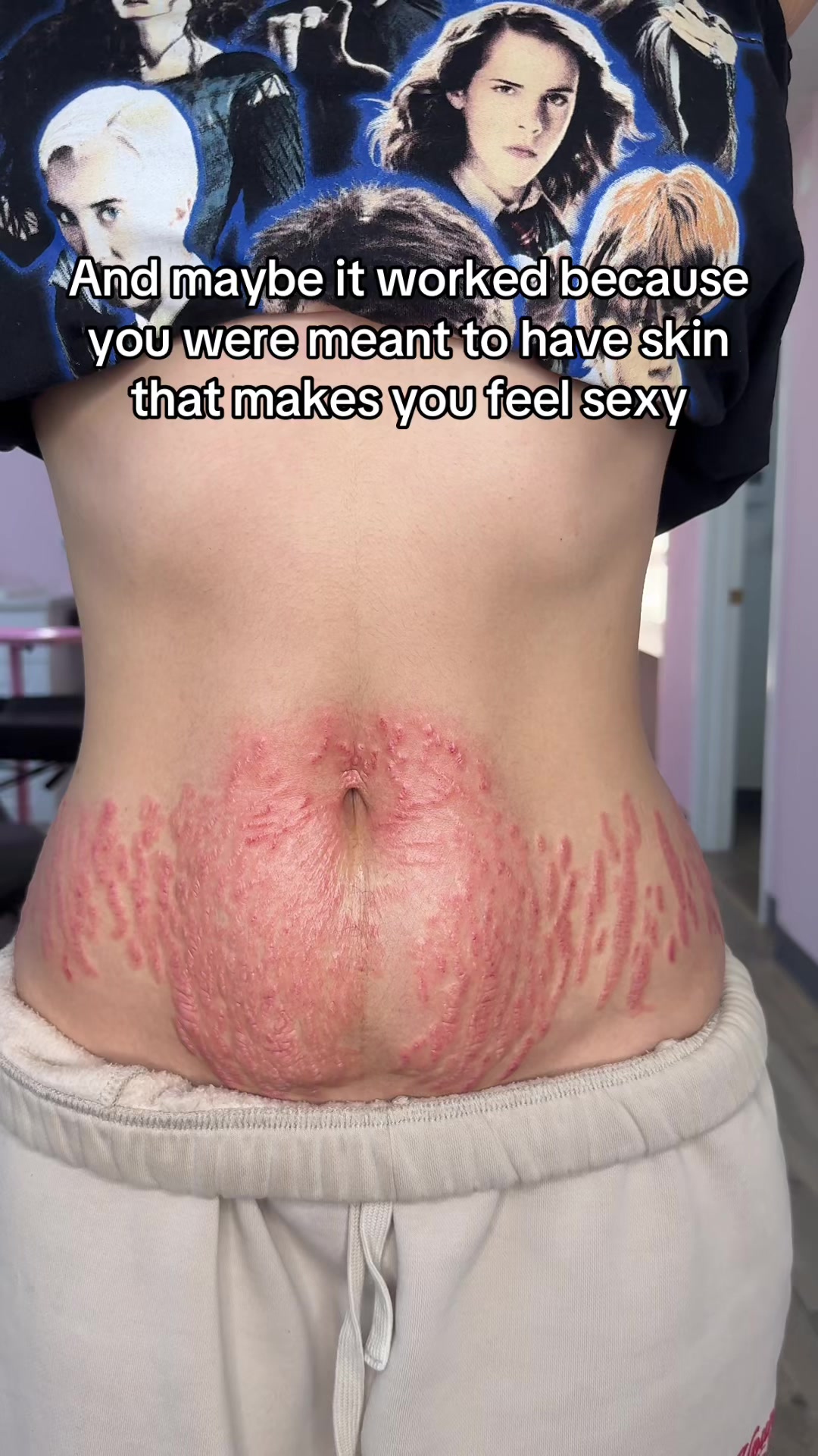 @Stretch Mark Fairy 🧚✨