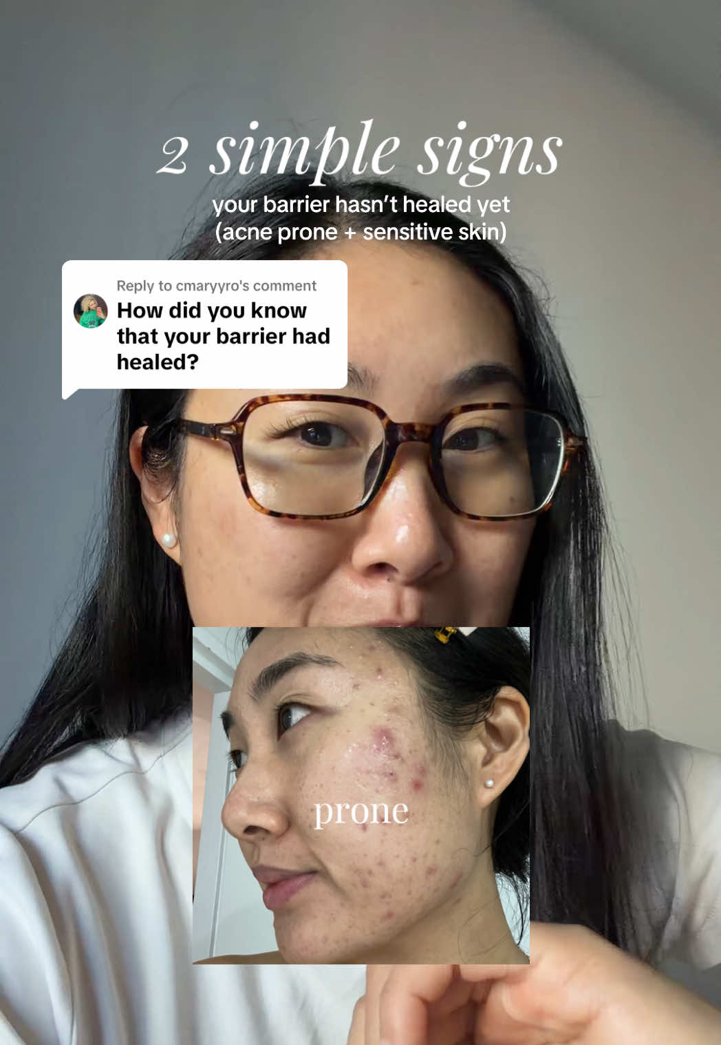 @Lisa | acne → clear skin