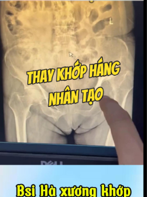 @Chuyên gia xương khớp