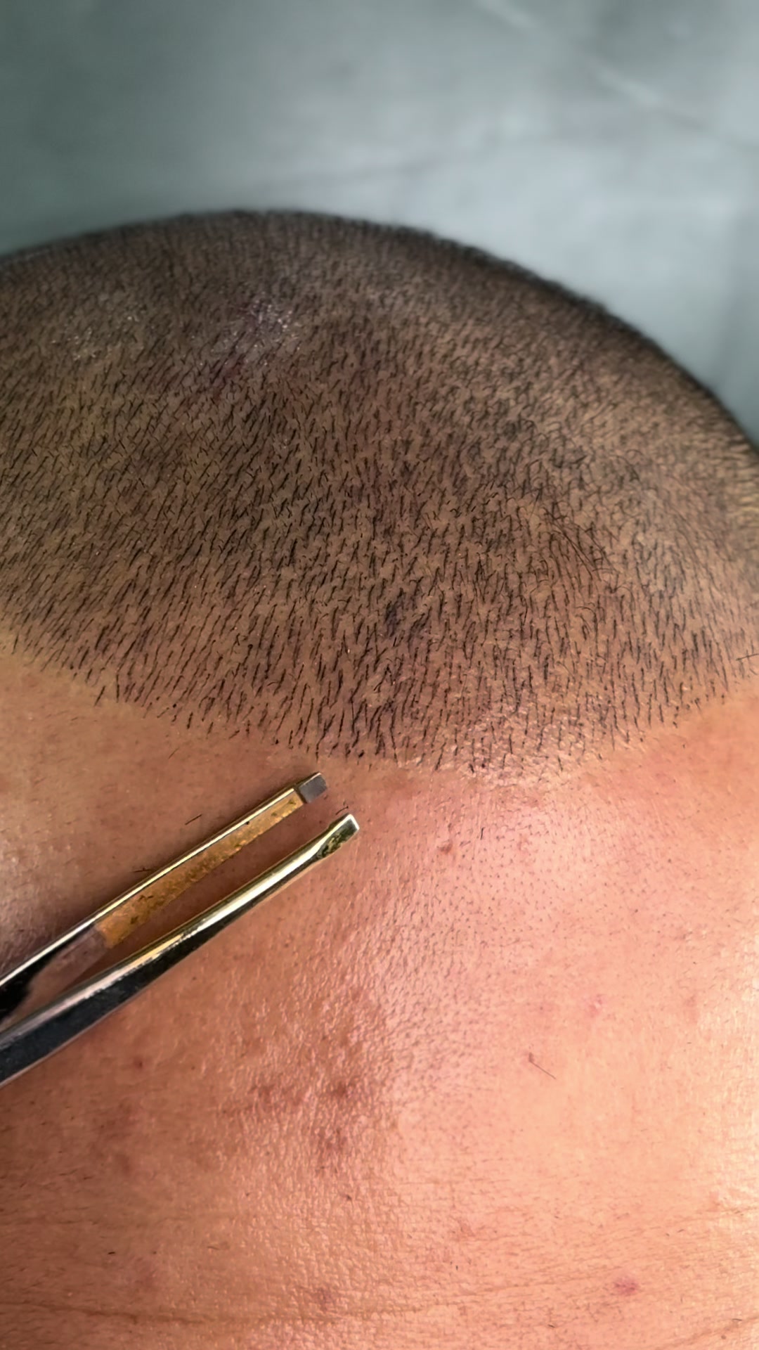 @Valesca Abi Ackel Scalp
