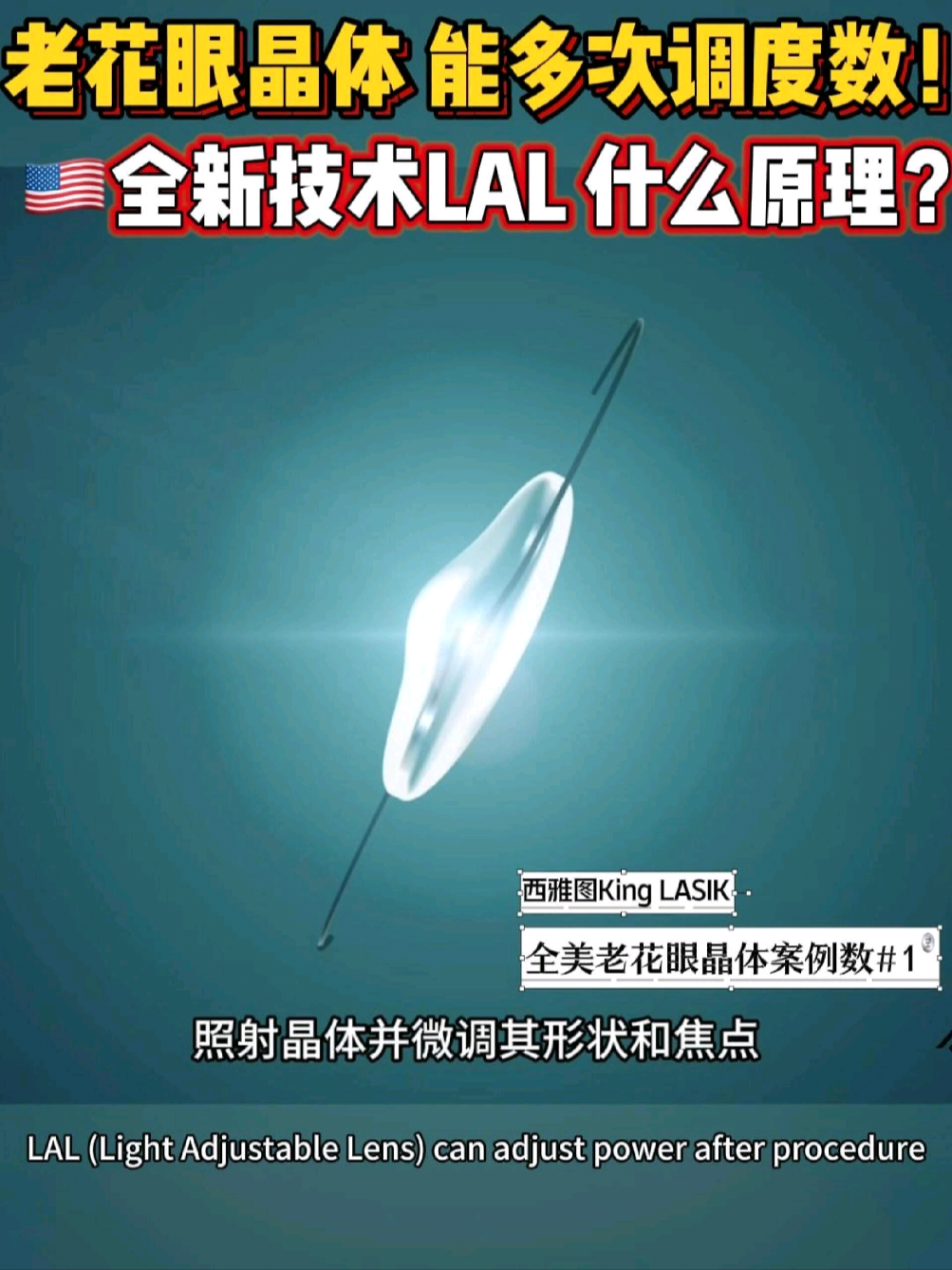 @🇺🇸西雅图/波特兰 King  Lasik 近视老花手术