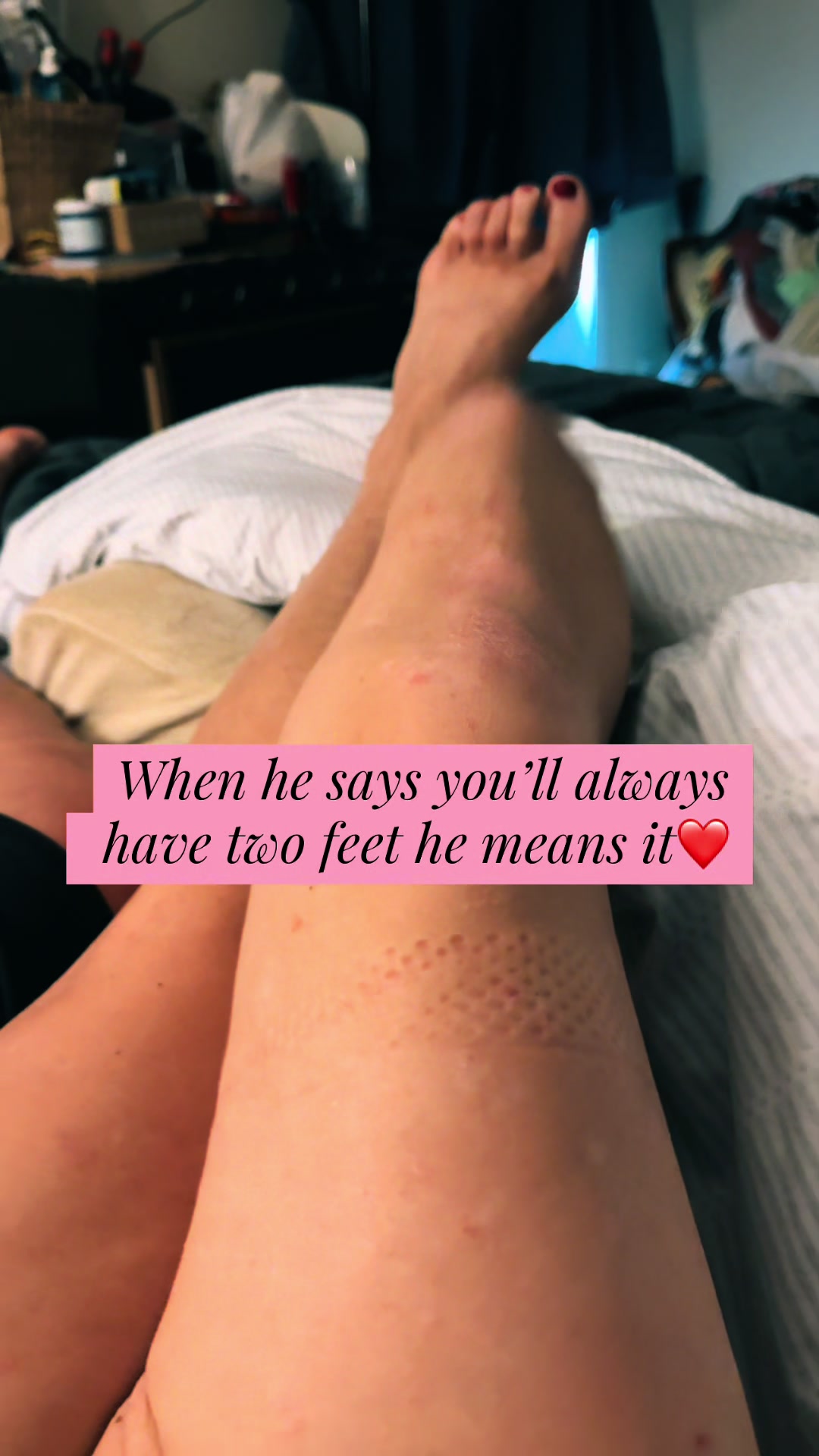 @Nikki | One Leg, Full Life 🦿