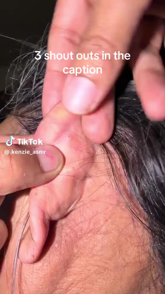 @Papa Pimple