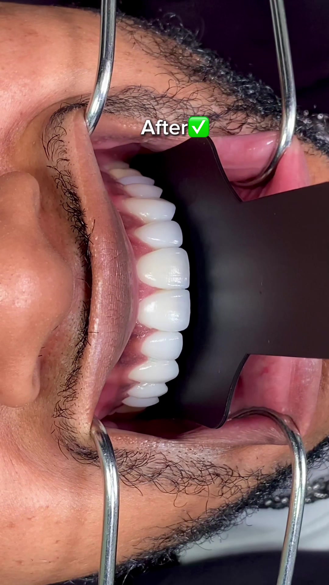@Veneers