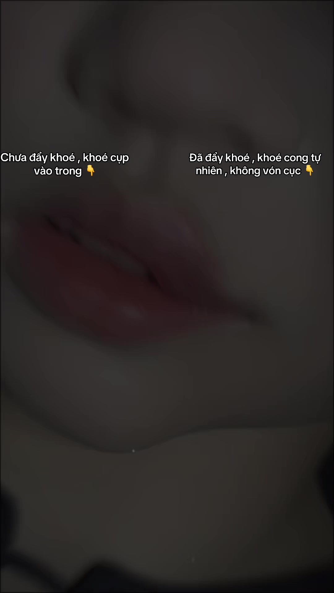 @TRẦN TRANG FILLER BÌNH THUẬN💉