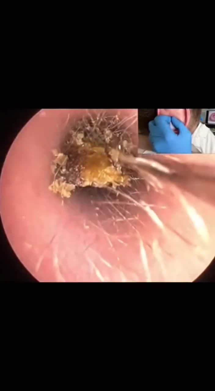 @Ear Cleaning